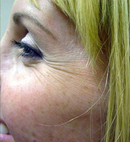 Before Wrinkle Reduction by Emelis Aesthetics in Dallas TX